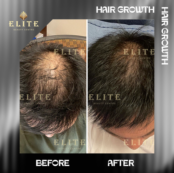 HAIR GROWTH